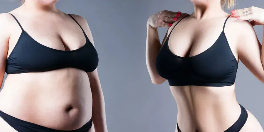 breast-lift-after-weight-loss-1