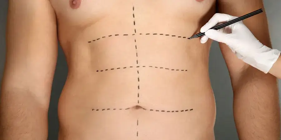 5-question-for-man-ask-before-having-a-tummy-tuck-1