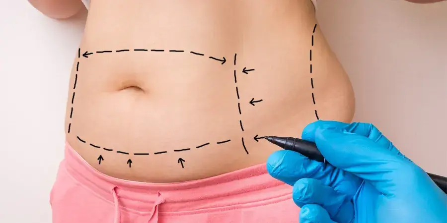 four-facts-that-affect-your-liposuction-result-1