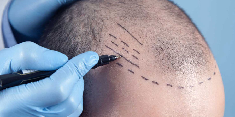 what-are-the-best-hair-transplant-methods-1