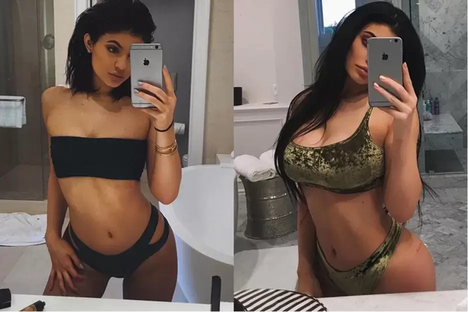 Kylie Jenner Before And After Plastic Surgery Mayclinik