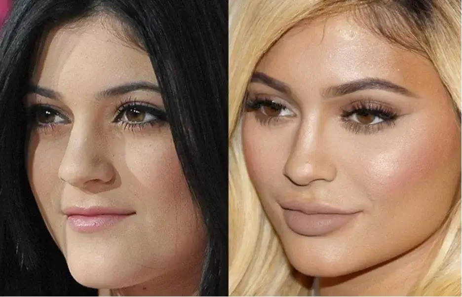 Kylie Jenner Before And After Plastic Surgery Mayclinik 8485