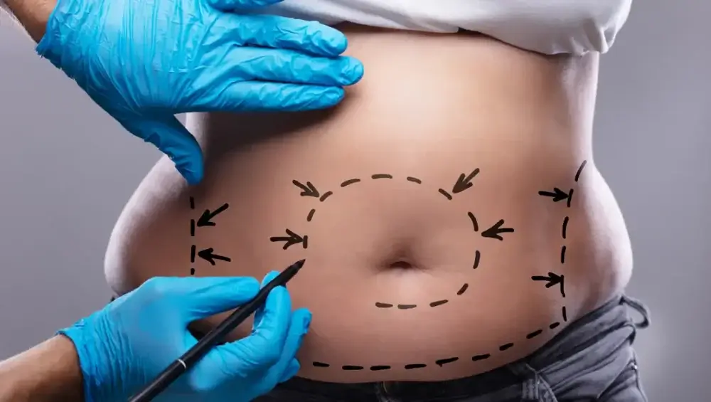 Abdominoplasty Operation in Turkey