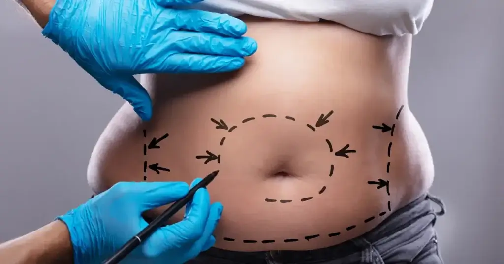 Abdominoplasty Operation in Turkey