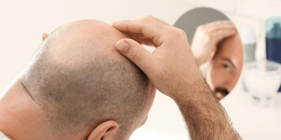 Where Does Male Pattern Baldness Come From