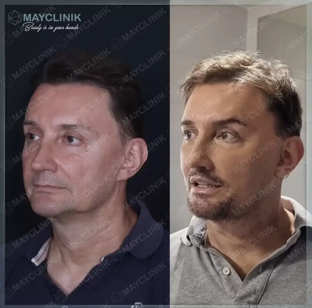deep plane facelift before after