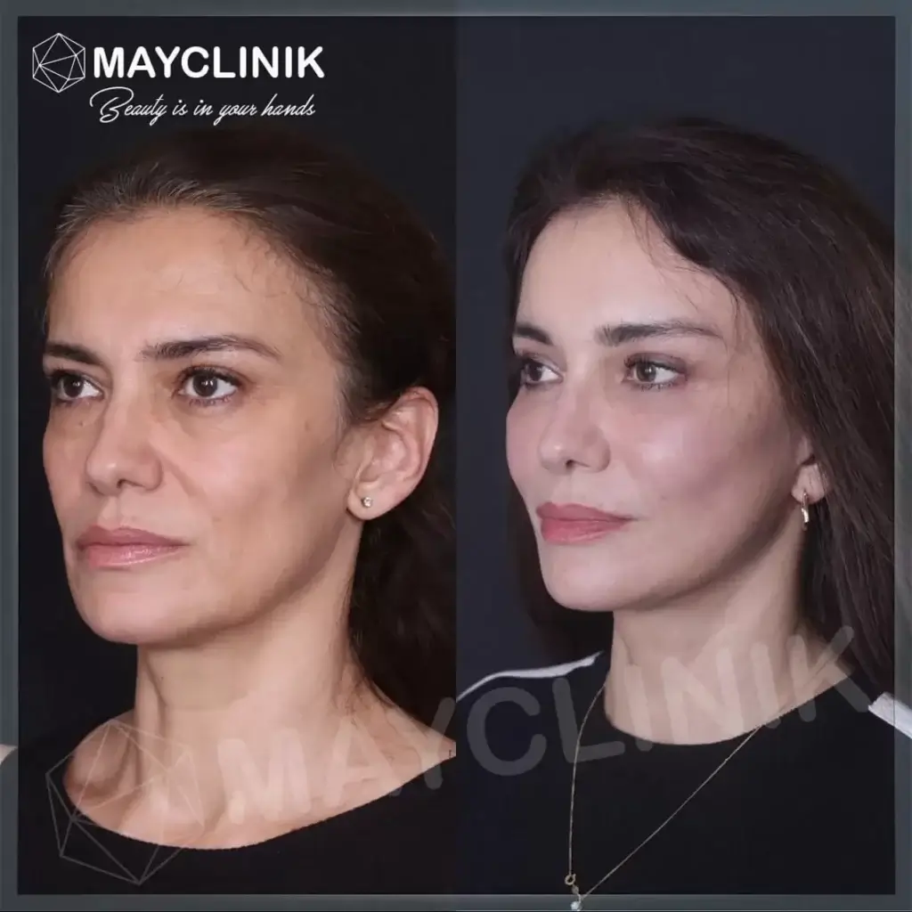 deep plane facelift before after