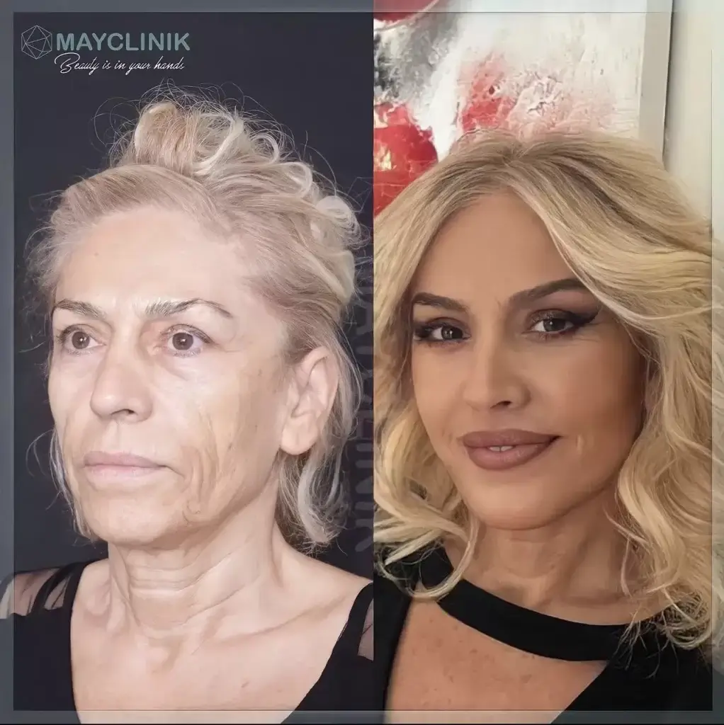 deep plane facelift before after
