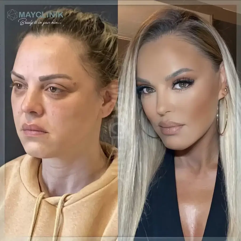 deep plane facelift before after