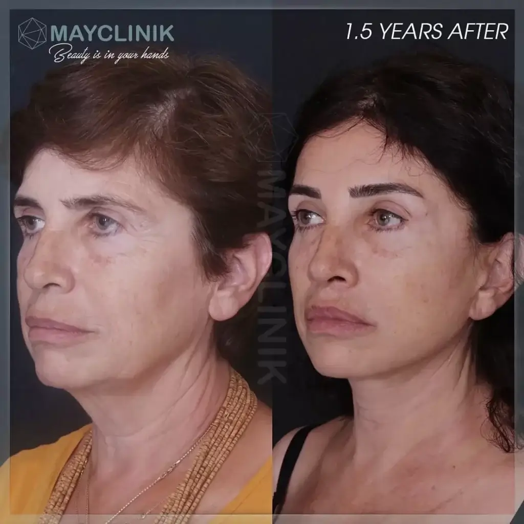 deep plane facelift before after