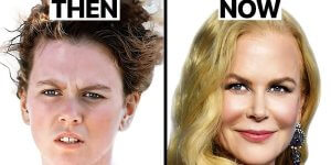 Nicole Kidman Plastic Surgery Before After