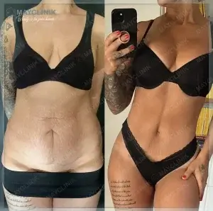 is mommy makeover safe in turkey