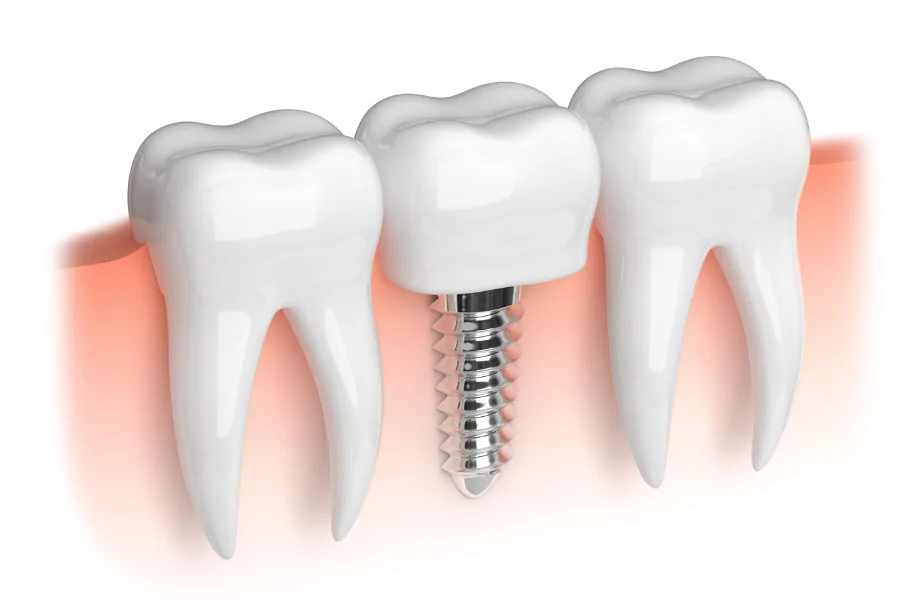 Dental Implant