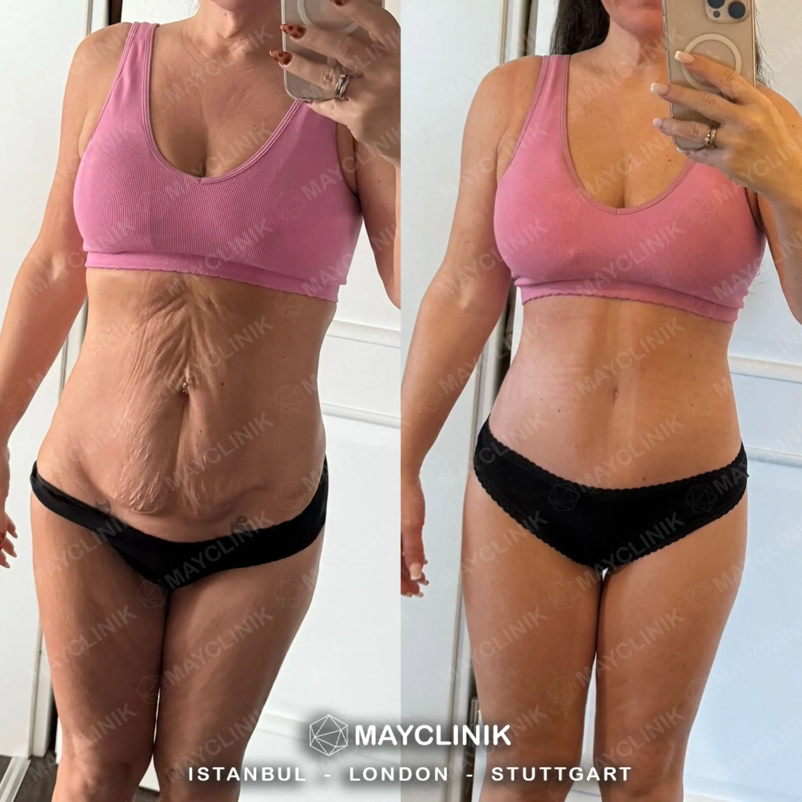 tummy tuck before after 6