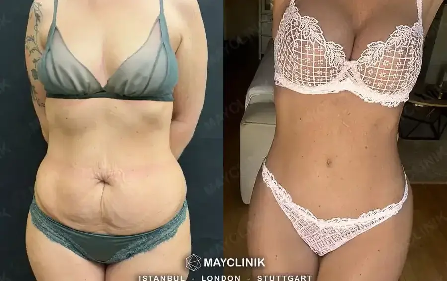 is mommy makeover safe in turkeyy