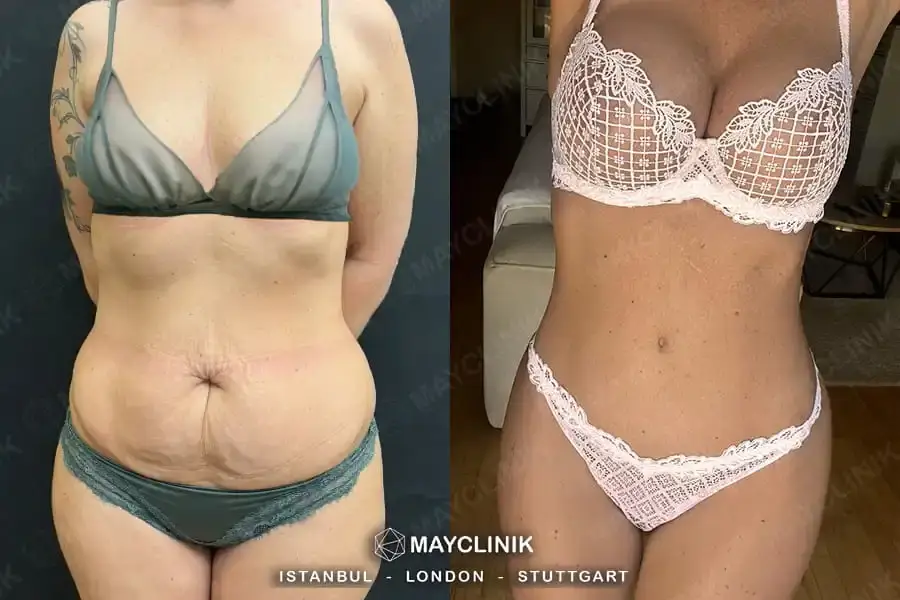 is mommy makeover safe in turkeyy
