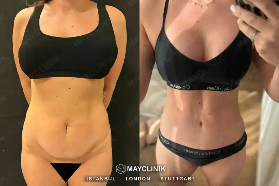 mommy makeover prices