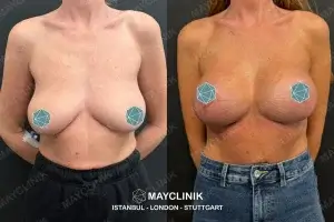 boob job