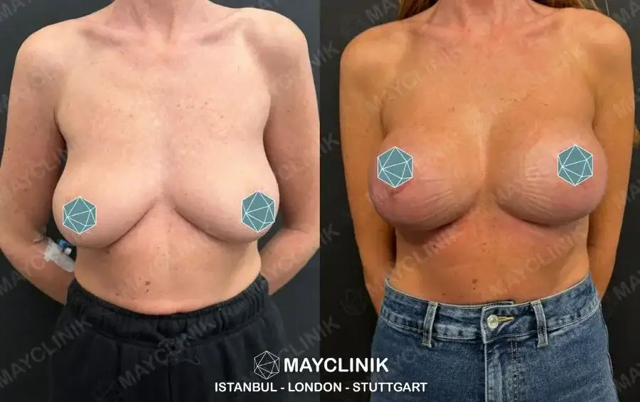 boob job