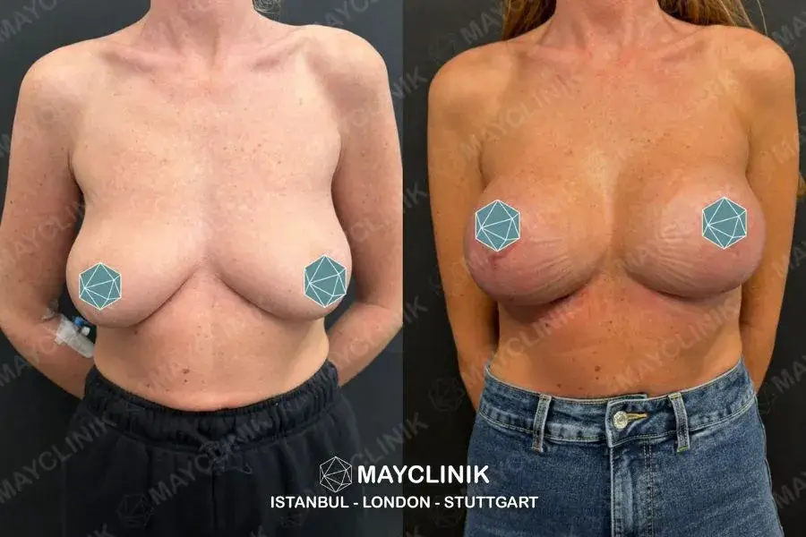 boob job