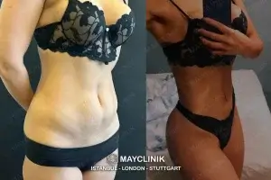 lipo 360 turkey