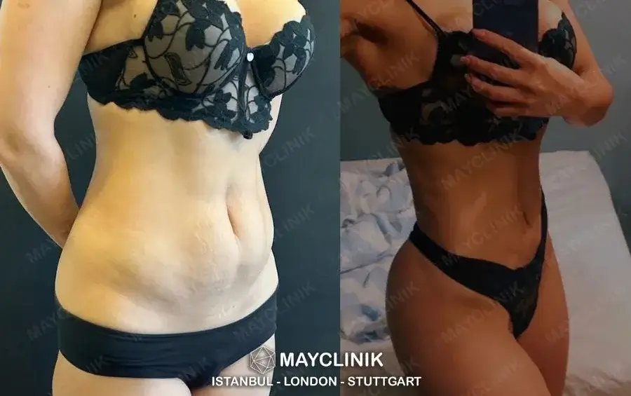 lipo 360 turkey