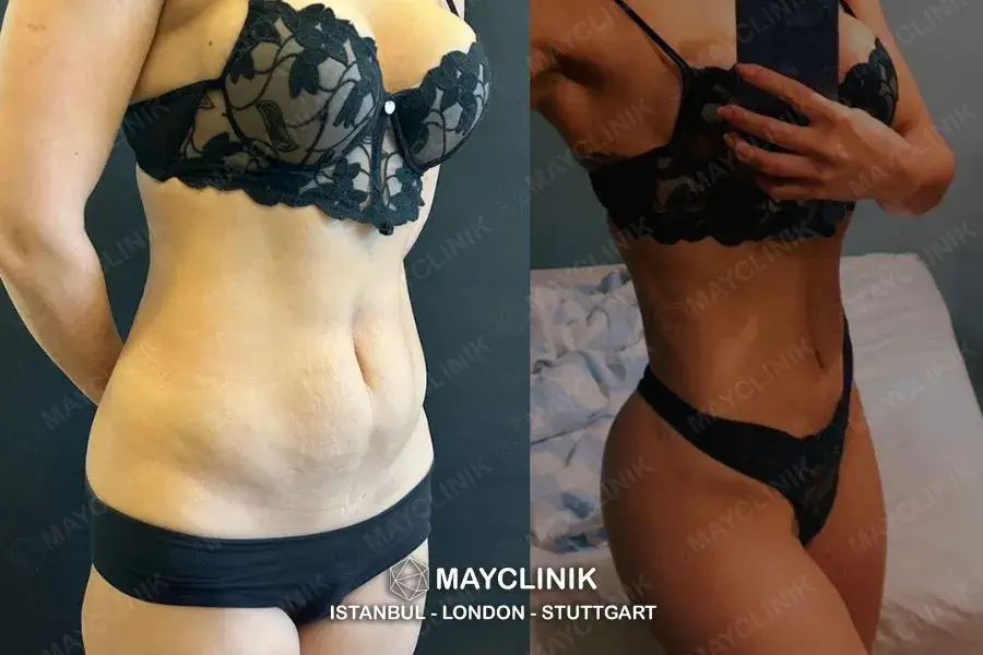 lipo 360 turkey