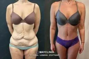 best surgeons for tummy tuck in turkey