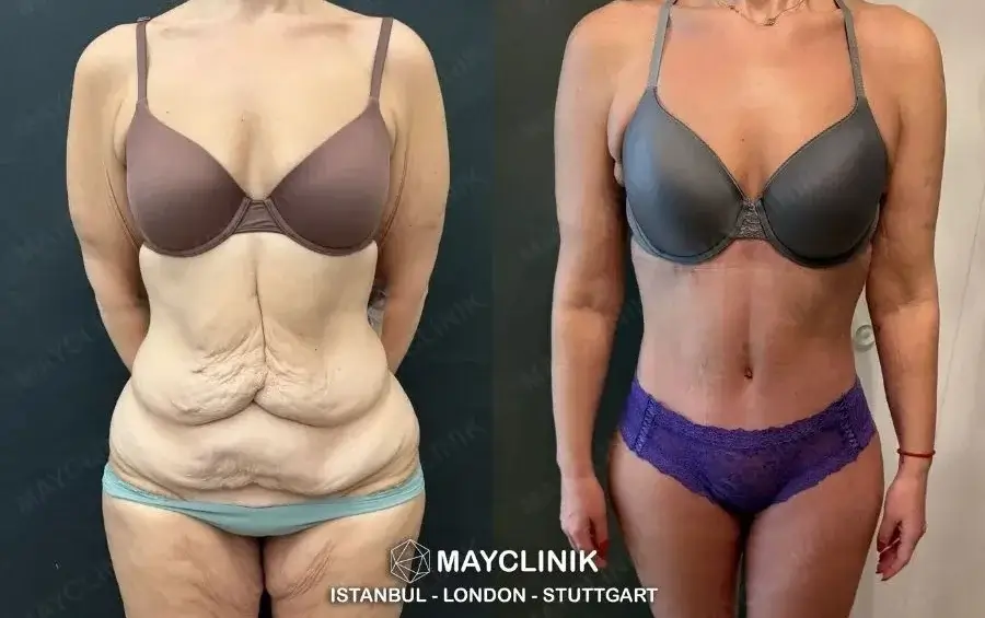 best surgeons for tummy tuck in turkey
