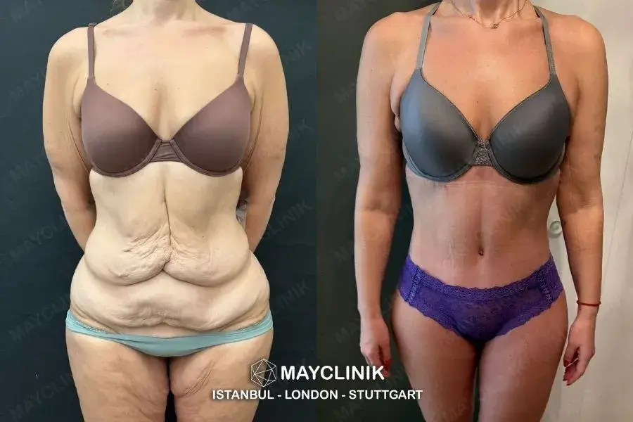 best surgeons for tummy tuck in turkey