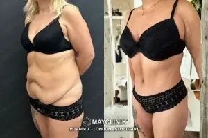how much does a tummy tuck in turkey