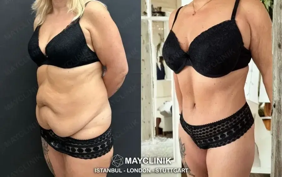 how much does a tummy tuck in turkey