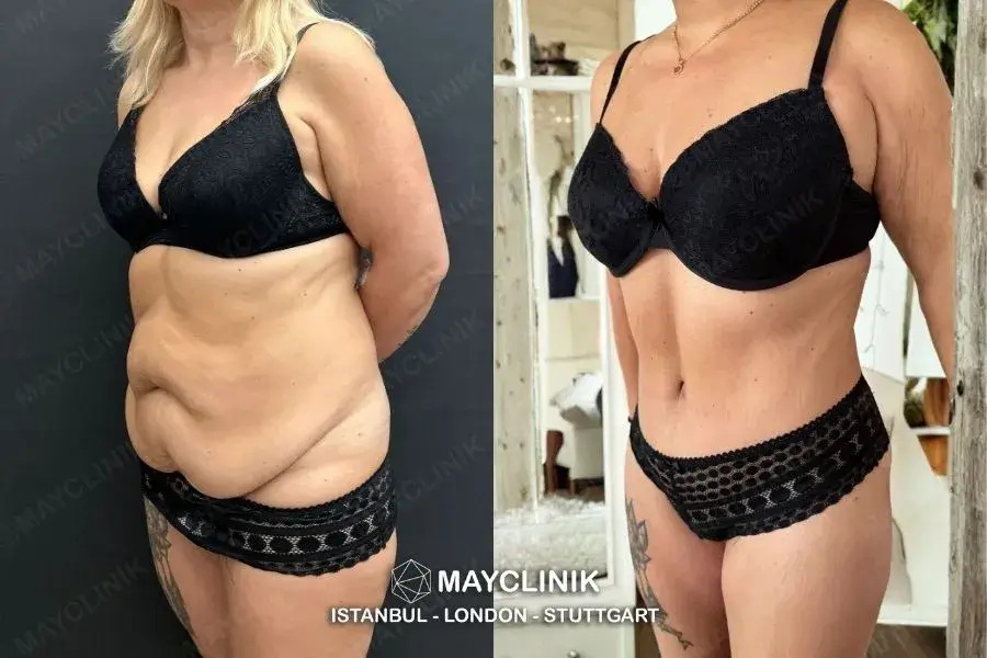how much does a tummy tuck in turkey