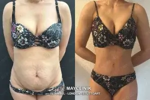 is tummy tuck safe in turkey