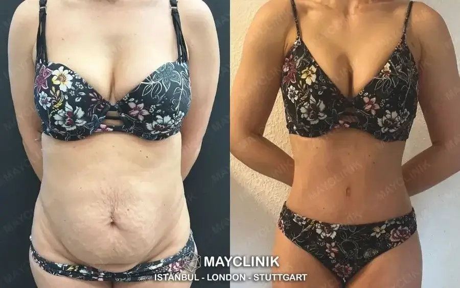 is tummy tuck safe in turkey