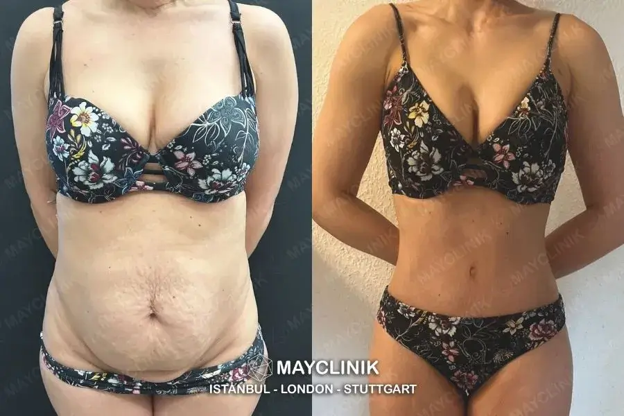 is tummy tuck safe in turkey