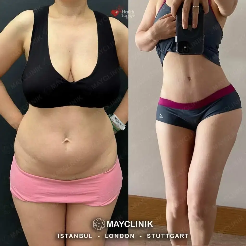 tummy tuck before after 101
