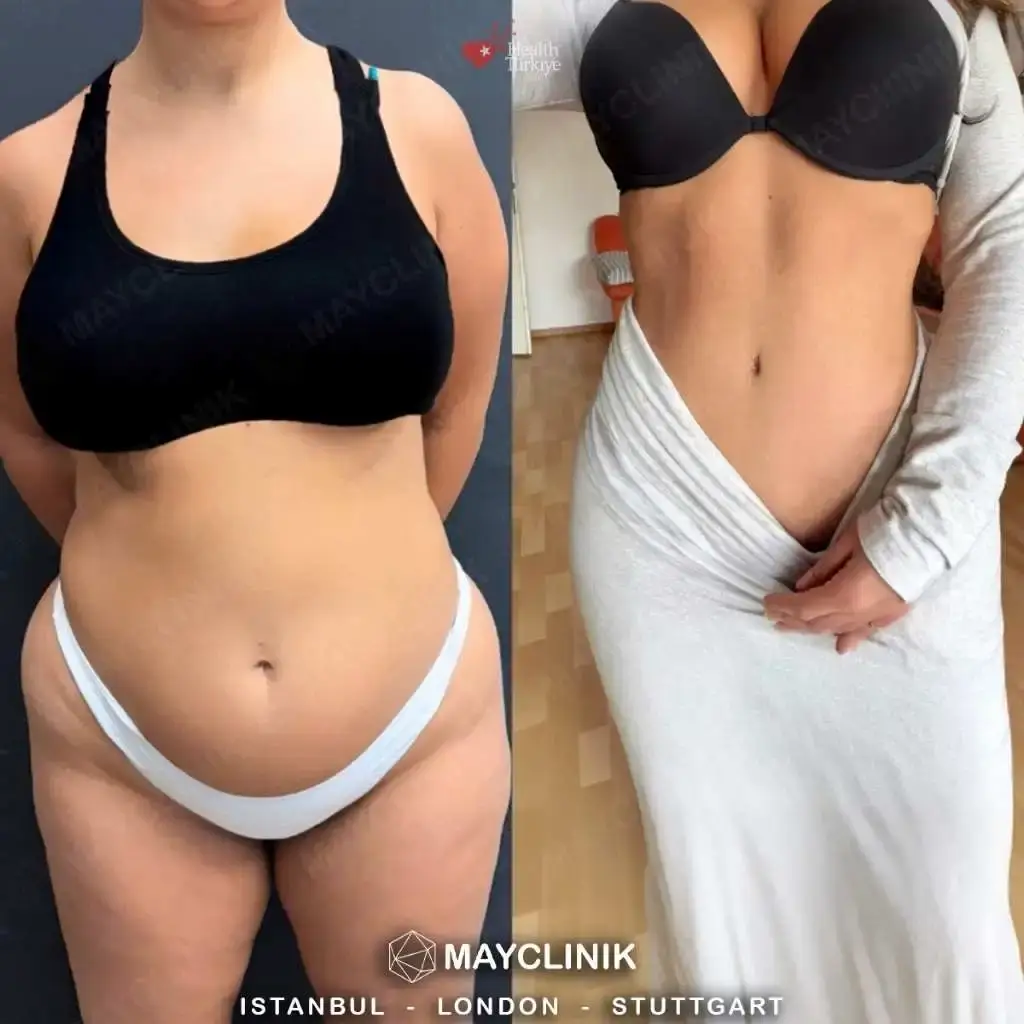 tummy tuck before after 61
