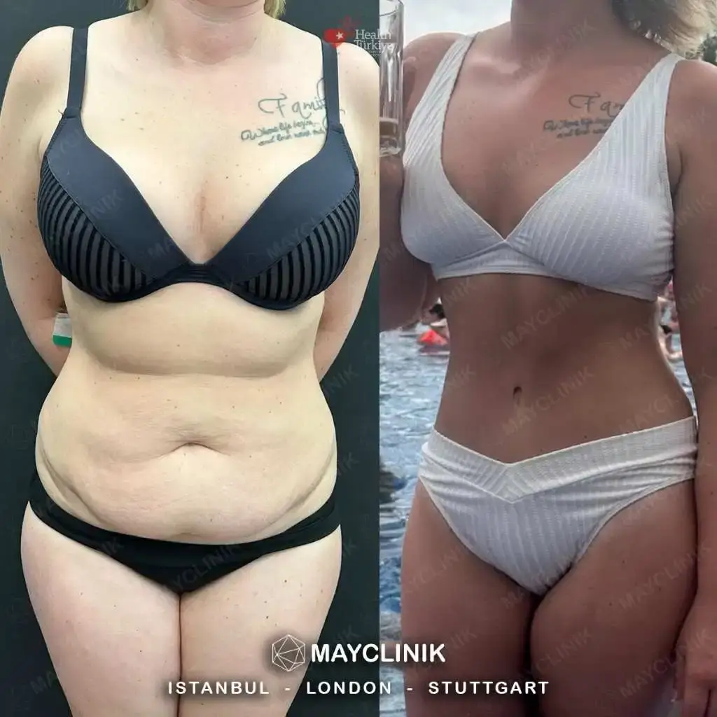 tummy tuck before after 81