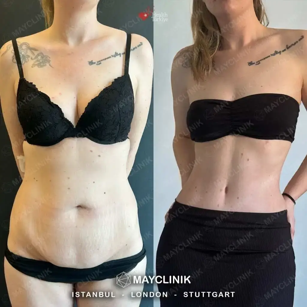 tummy tuck before after 91