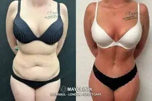 why is tummy tuck cheaper in turkey