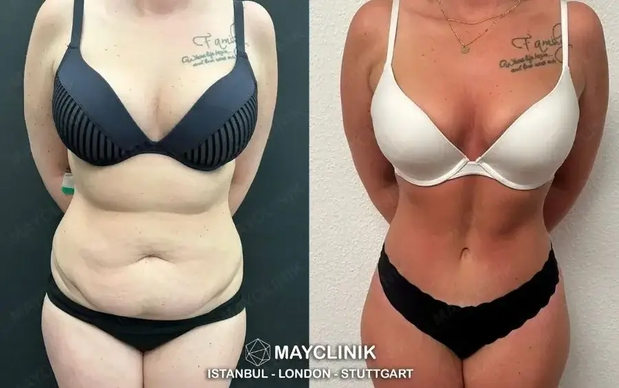 why is tummy tuck cheaper in turkey