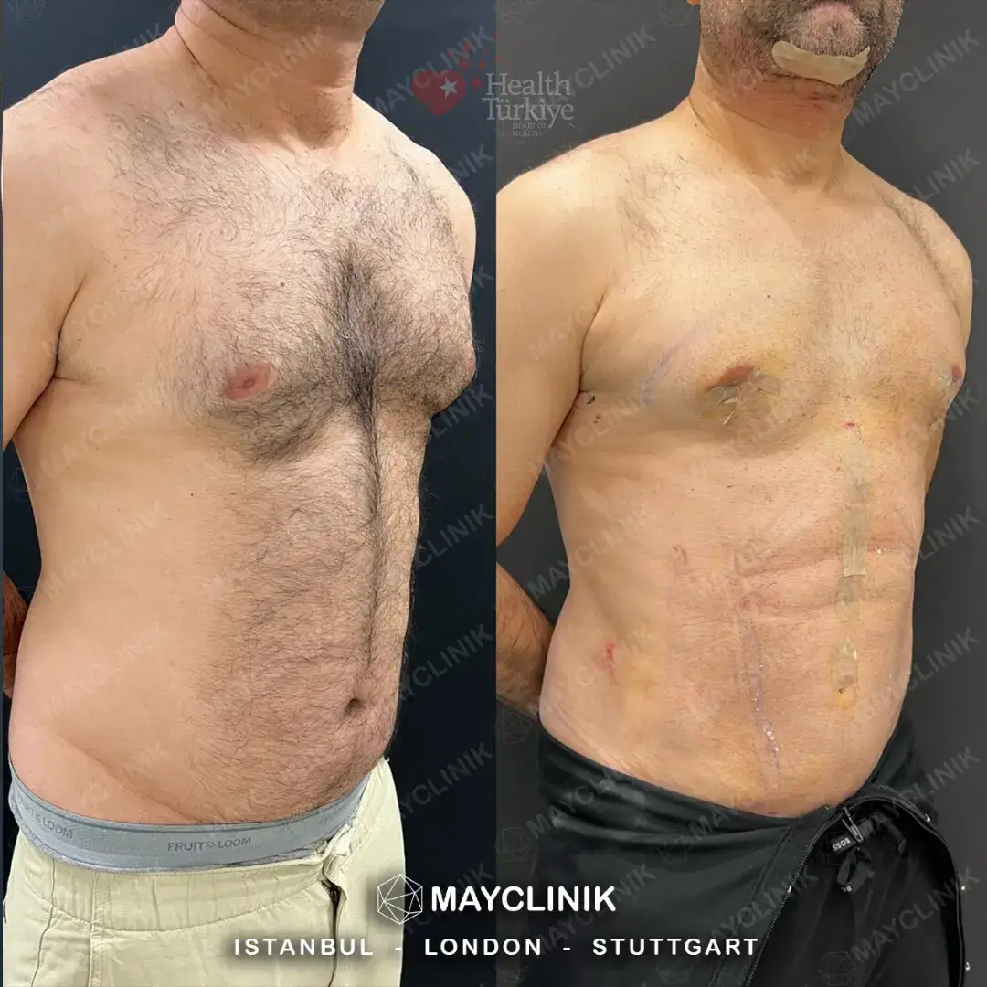daddy makeover turkey gynecomastia