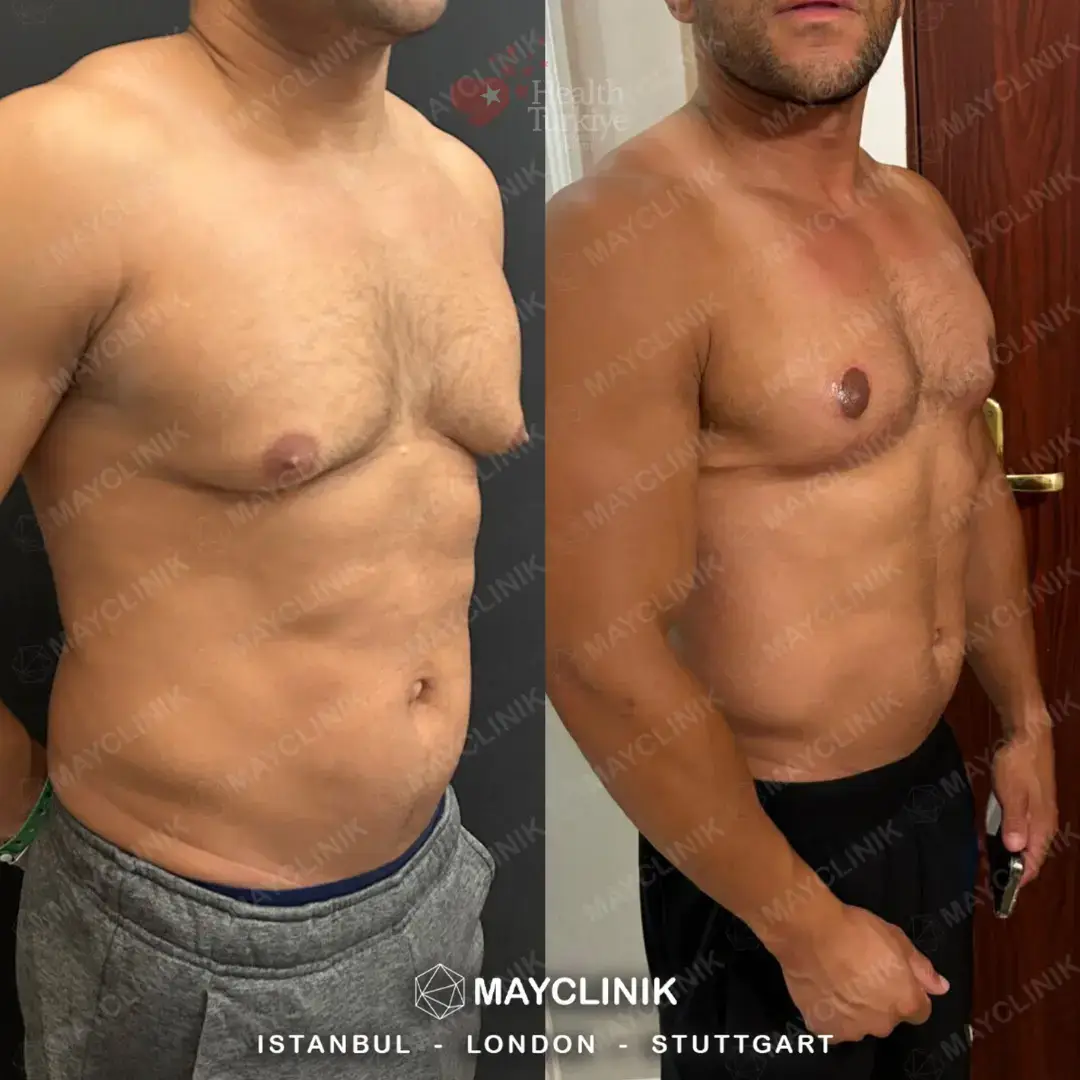 daddy makeover turkey gynecomastia 2