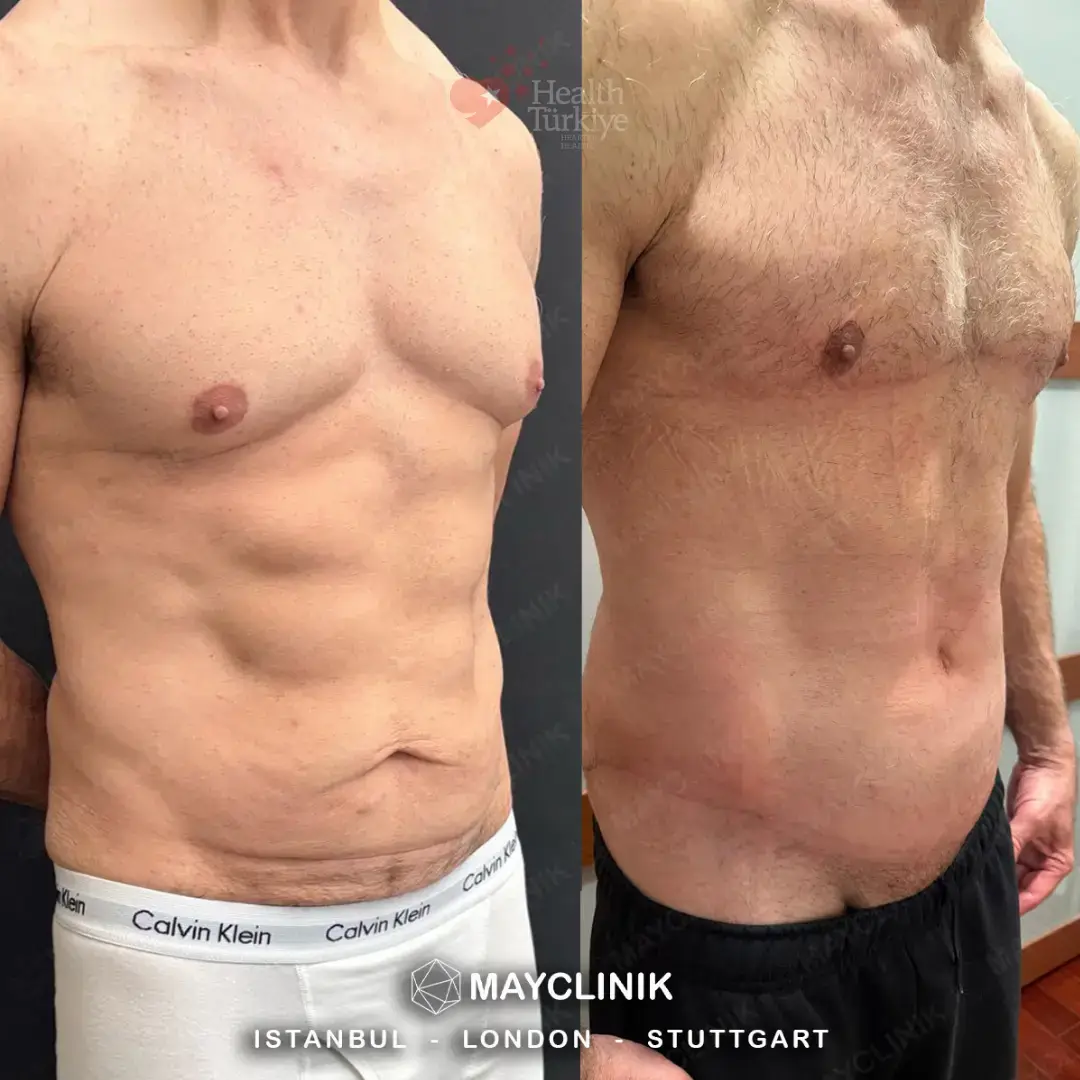 daddy makeover turkey gynecomastia 3