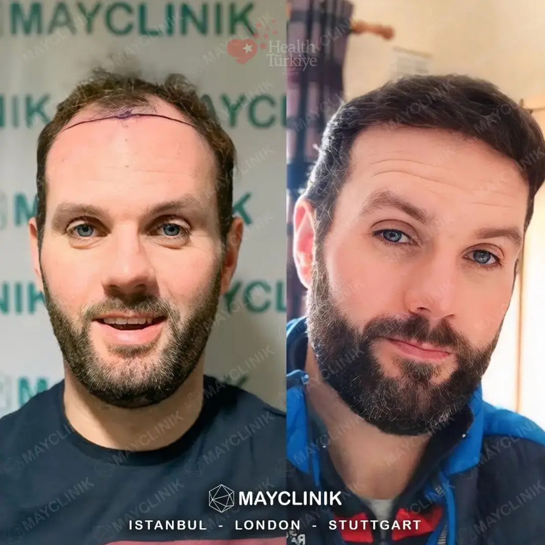 daddy makeover turkey hair translant 2