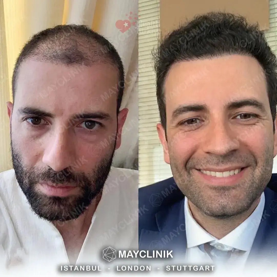 daddy makeover turkey hair transplant 3
