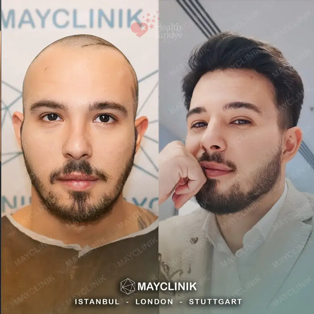 daddy makeover turkey hair transplant
