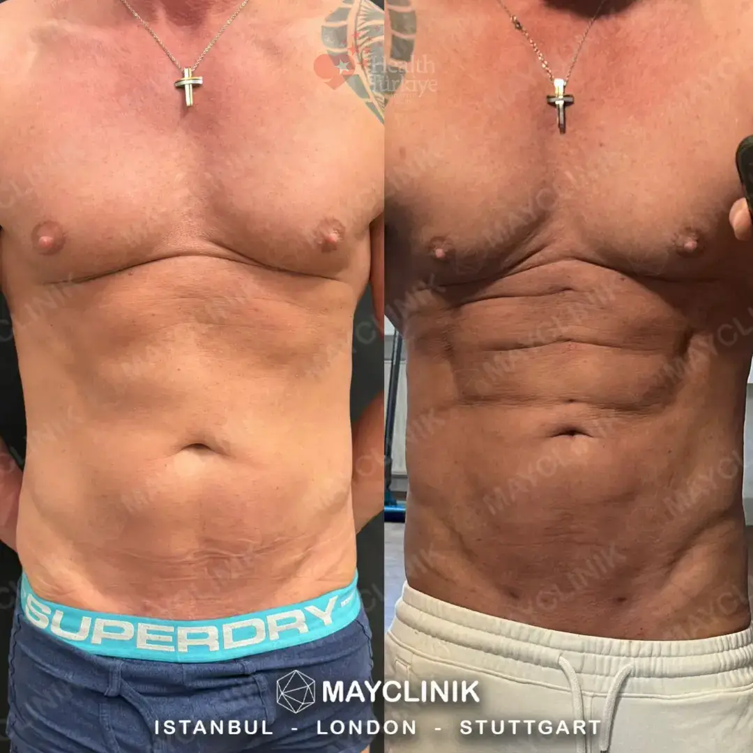 daddy makeover turkey tummy tuck 2