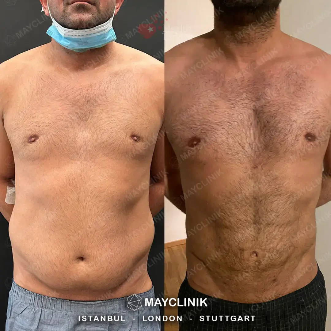 daddy makeover turkey tummy tuck 3